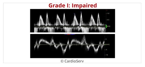 impaired lv relaxation on echo.